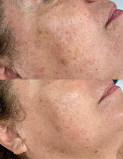 Vorher Nacher NOA Beauty Glattpark